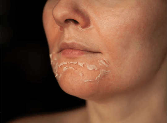 Peeling Químico