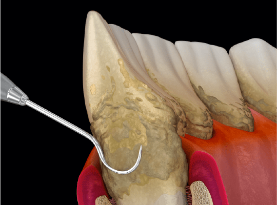 Periodoncia
