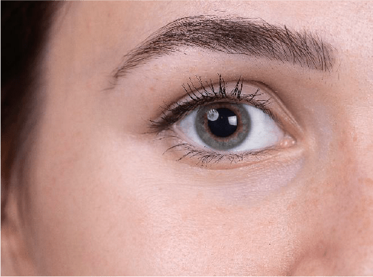 Relleno de Ojeras