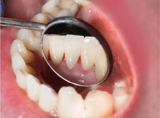 Periodoncia