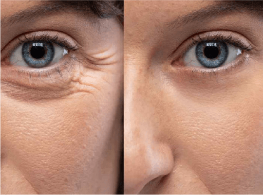 Relleno de Ojeras
